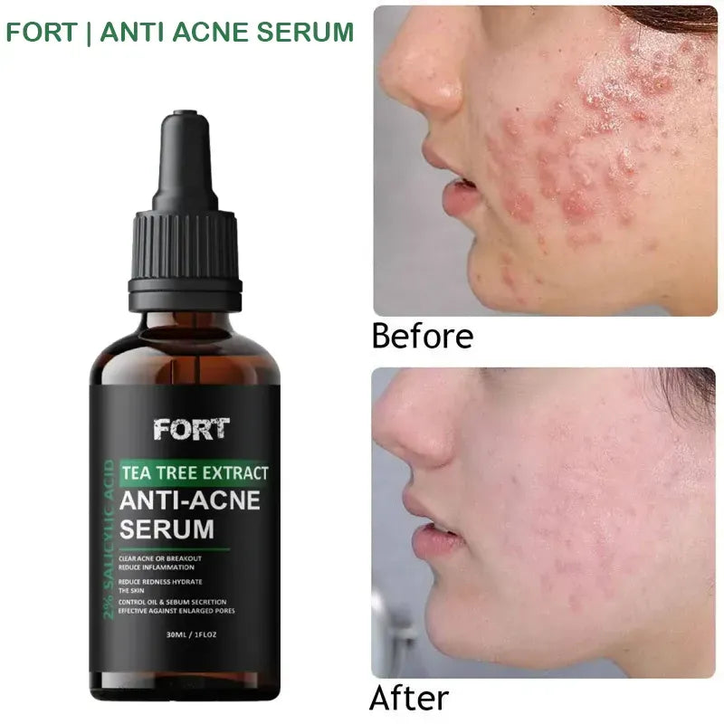 FORT Salicylic Acid Serum – Anti-Acne Face Serum & Dark Spot Correcting Serum for Glowing Skin | Acne Skin Care Products
